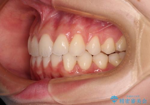 前歯のデコボコと深い咬み合わせ インビザラインできれいに改善の治療後
