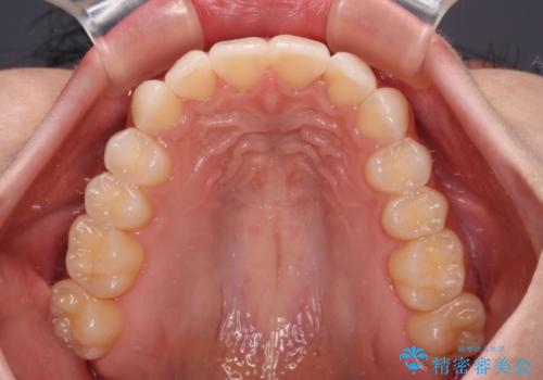 前歯のデコボコと深い咬み合わせ インビザラインできれいに改善の治療後