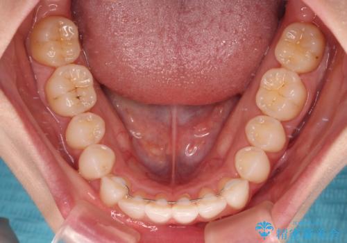 前歯のデコボコと深い咬み合わせ　インビザラインできれいに改善の治療後