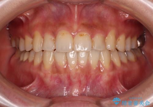 前歯のデコボコとクロスバイト　インビザラインによる矯正治療の症例 治療後