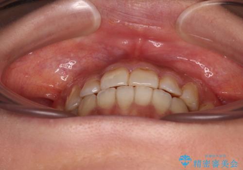 前歯のデコボコとクロスバイト インビザラインによる矯正治療の治療後