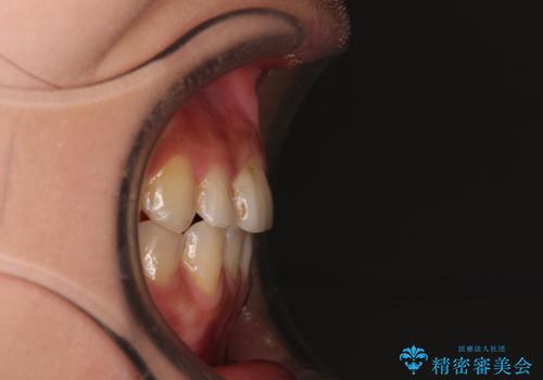 前歯のデコボコとクロスバイト インビザラインによる矯正治療の治療後