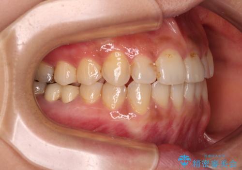 前歯のデコボコとクロスバイト　インビザラインによる矯正治療の治療後
