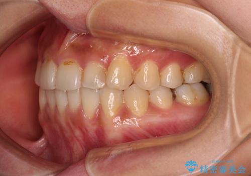 前歯のデコボコとクロスバイト インビザラインによる矯正治療の治療後