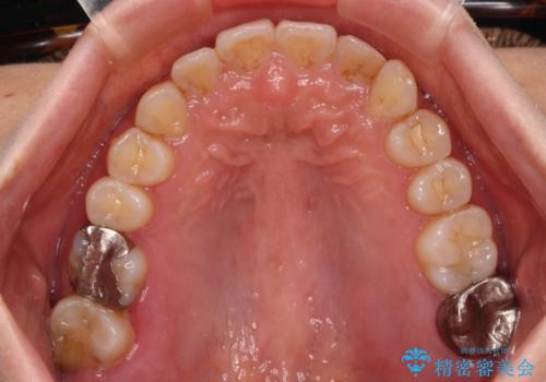 前歯のデコボコとクロスバイト インビザラインによる矯正治療の治療後