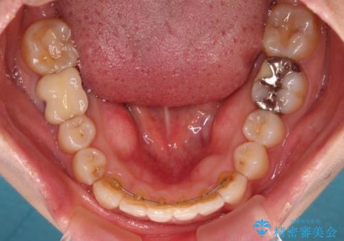 前歯のデコボコとクロスバイト インビザラインによる矯正治療の治療後