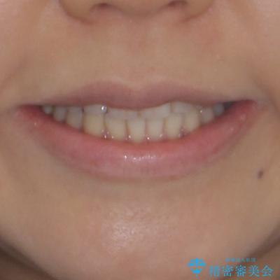 前歯のデコボコとクロスバイト　インビザラインによる矯正治療の治療後（顔貌）