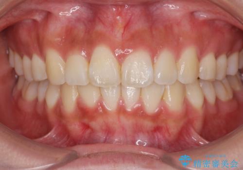 ワイヤーの小矯正を行い、治療期間を短縮するマウスピース治療の治療後