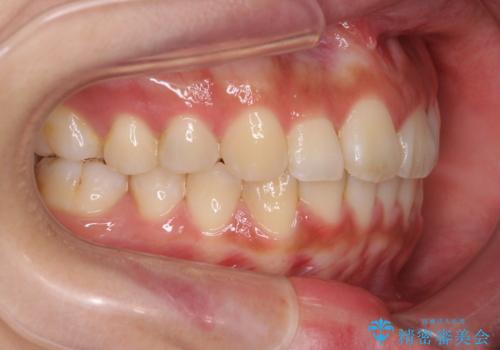 ワイヤーの小矯正を行い、治療期間を短縮するマウスピース治療の治療後