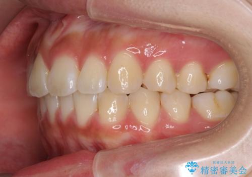 ワイヤーの小矯正を行い、治療期間を短縮するマウスピース治療の治療後
