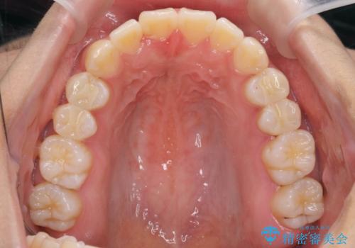 ワイヤーの小矯正を行い、治療期間を短縮するマウスピース治療の治療後