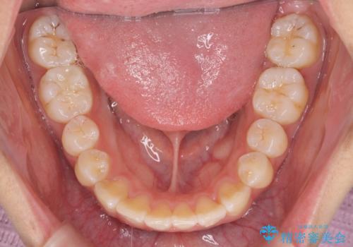 ワイヤーの小矯正を行い、治療期間を短縮するマウスピース治療の治療後