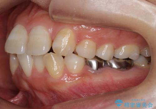歯のがたつき　インビザラインで矯正の治療前