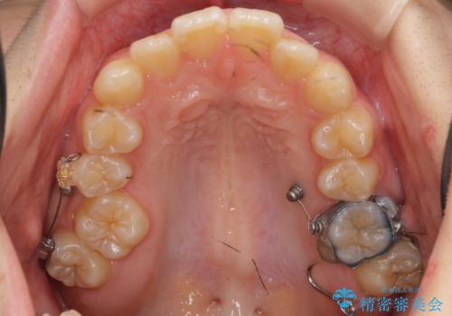 奥歯のかみ合わせも妥協しない　インビザライン治療の治療中