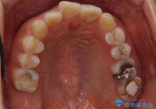 歯のがたつき　インビザラインで矯正の治療前
