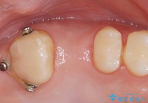 銀の詰め物を白くしたい。の治療後