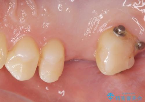 銀の詰め物を白くしたい。の治療後