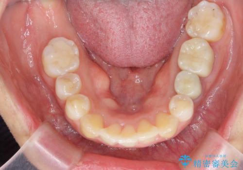 歯のがたつき　インビザラインで矯正の治療後
