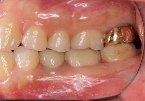 歯の高さがない 被せ物のやりなおしの治療後