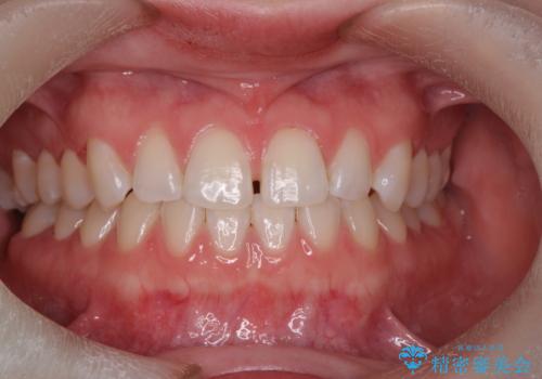 オフィスホワイトニングで、白い歯に!!の症例 治療前