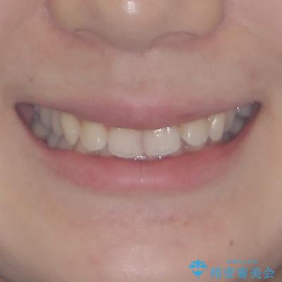 前歯のデコボコと深い咬み合わせ　インビザラインできれいに改善の治療前（顔貌）