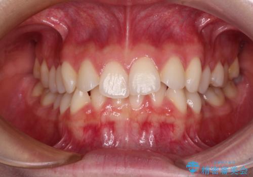 前歯のデコボコと深い咬み合わせ　インビザラインできれいに改善の治療前
