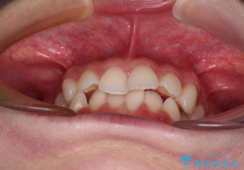 前歯のデコボコと深い咬み合わせ インビザラインできれいに改善の治療前