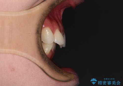 前歯のデコボコと深い咬み合わせ インビザラインできれいに改善の治療前