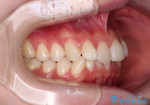 前歯のデコボコと深い咬み合わせ　インビザラインできれいに改善の治療前