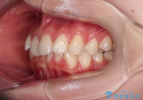 前歯のデコボコと深い咬み合わせ インビザラインできれいに改善の治療前