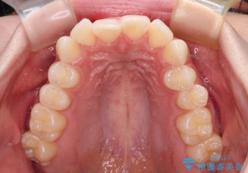 前歯のデコボコと深い咬み合わせ インビザラインできれいに改善の治療前