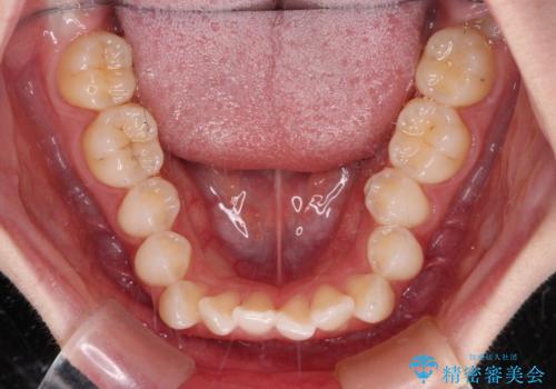 前歯のデコボコと深い咬み合わせ インビザラインできれいに改善の治療前