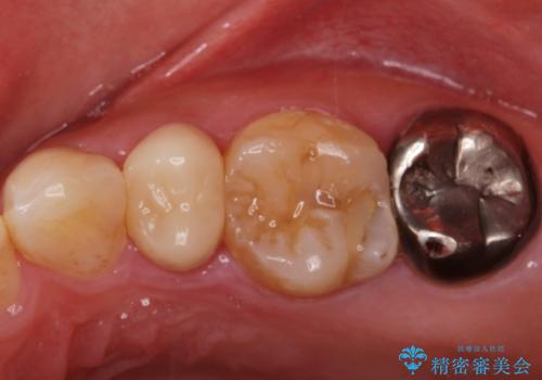 保険で被せた白い被せ物をやりかえたい。の治療前