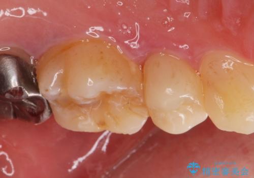 保険で被せた白い被せ物をやりかえたい。の治療前