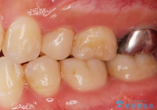 保険で被せた白い被せ物をやりかえたい。の治療前