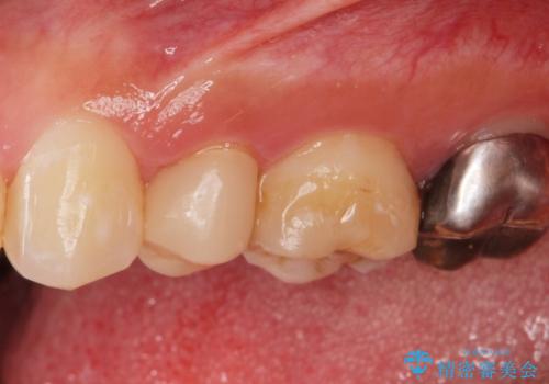 保険で被せた白い被せ物をやりかえたい。の治療前