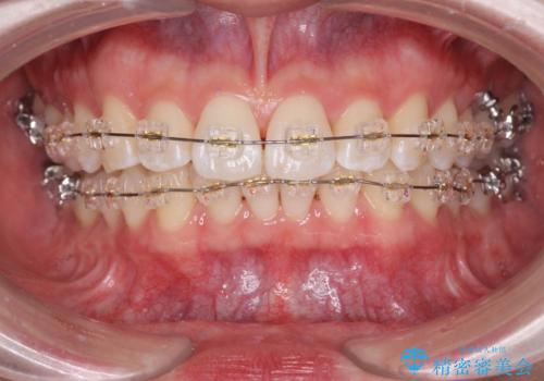 ワイヤー矯正がしたい