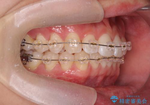 ワイヤー矯正がしたいの治療中