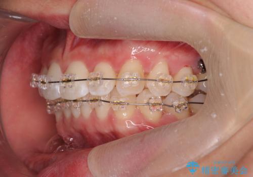 ワイヤー矯正がしたいの治療中