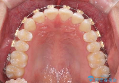 ワイヤー矯正がしたいの治療中