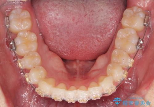 ワイヤー矯正がしたいの治療中