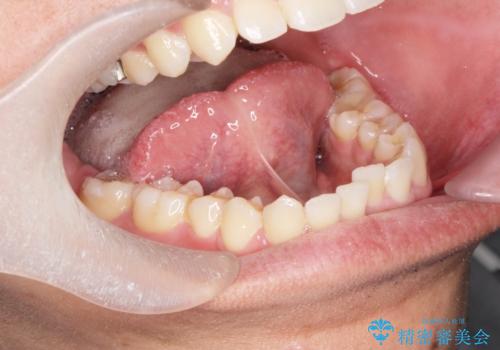 [滑舌を治したい] 舌の小帯の形成術の症例 治療前