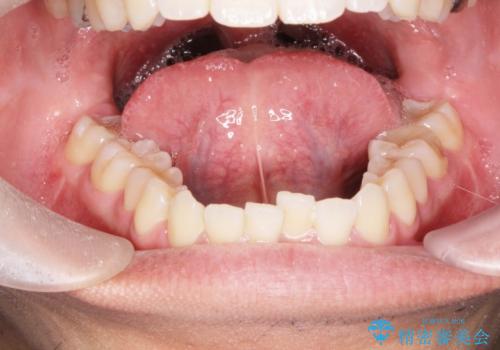 [滑舌を治したい] 舌の小帯の形成術の治療前