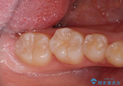 矯正治療前の親知らず抜歯の症例 治療前