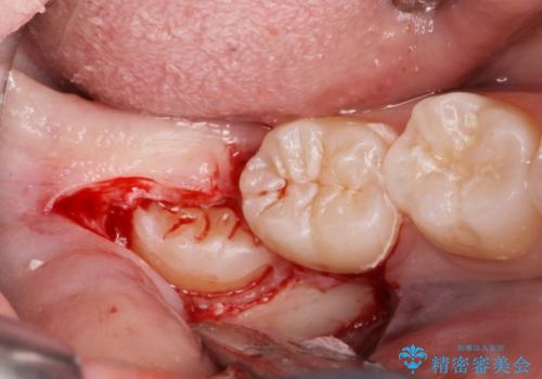 矯正治療前の親知らず抜歯の治療中