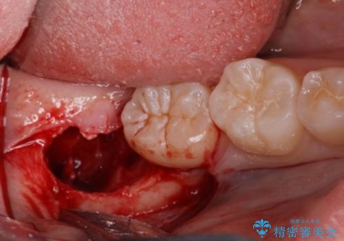 矯正治療前の親知らず抜歯の治療中