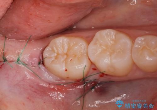 矯正治療前の親知らず抜歯の症例 治療後