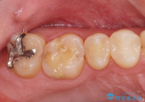 銀の詰め物をやりかえたい