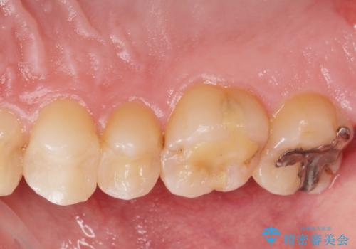 銀の詰め物をやりかえたいの治療前