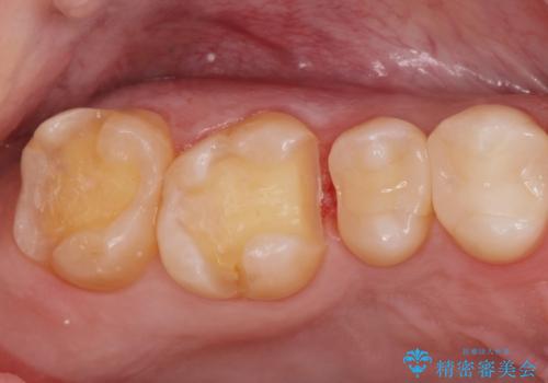 銀の詰め物をやりかえたいの治療中